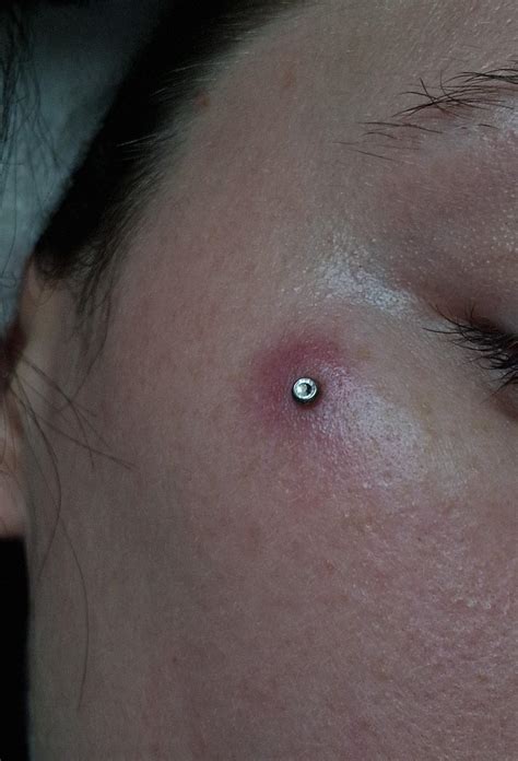 Cheek Bone Micro Dermal Piercings