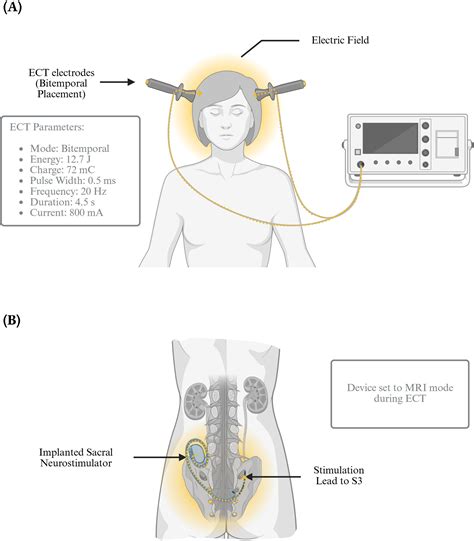 Frontiers | Electroconvulsive therapy in a patient with an implanted sacral neurostimulator: a ...