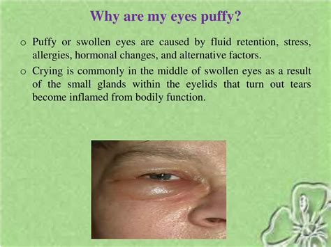 PPT - How to get rid of puffy eyes naturally PowerPoint Presentation, free download - ID:7401765