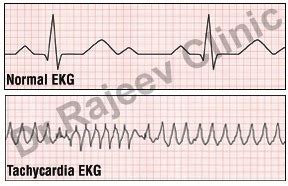 homeopathic treatment for Tachycardia in homeopathy, Tachycardia ...