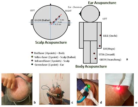 Multimodal Laser Stimulation and Traditional Needle Acupuncture in Post ...