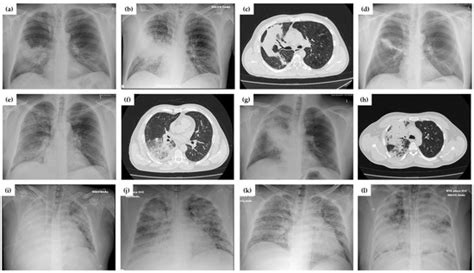 Adenoviral Pneumonia Outbreak in Immunocompetent Adults—A Missed ...
