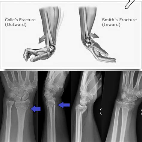 Smith Vs Colles Fracture Distal Radius Fracture: Diagnosis, Treatment,