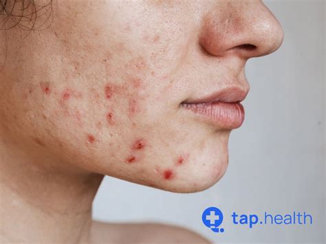Home Remedies for Acne Scars Overnight: A Natural Approach