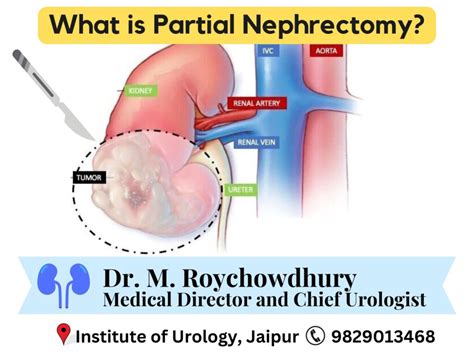 Image result for Steps of Partial Nephrectomy