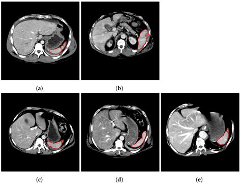 Automated Spleen Injury Detection Using 3D Active Contours and Machine ...