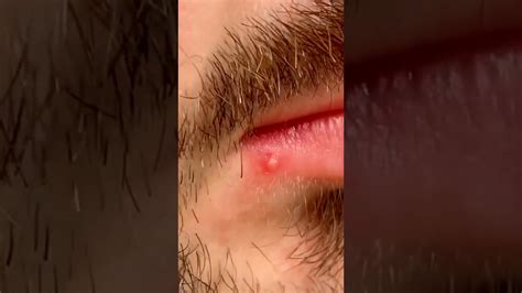 Image result for Largest Infected Exploding Cyst Carbuncle Blackhead