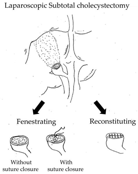 Suture Versus Non-Suture Closure of the Cystic Duct Orifice During ...