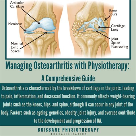 Osteoarthritis Physiotherapy New Treatments For Osteoarthritis Of The
