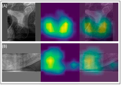 AI-Powered Identification of Osteoporosis in Dental Panoramic ...