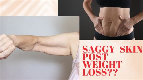 Saggy Skin Post Weight Loss? — Roshni Sanghvi