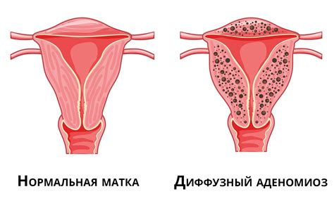 Диффузный аденомиоз матки: причины, симптомы, признаки, лечение