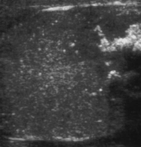 Testicular Microlithiasis Prevalence and Tumor Risk in a Population Referred for Scrotal ...