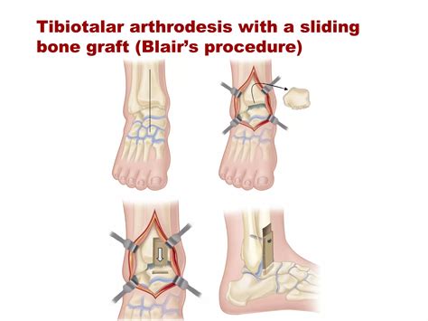 Ankle and foot arthrodesis | PPT