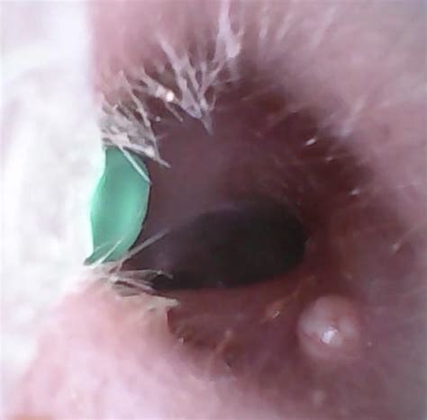 Solid bump in the ear canal, very painful and leaking white discharge ...