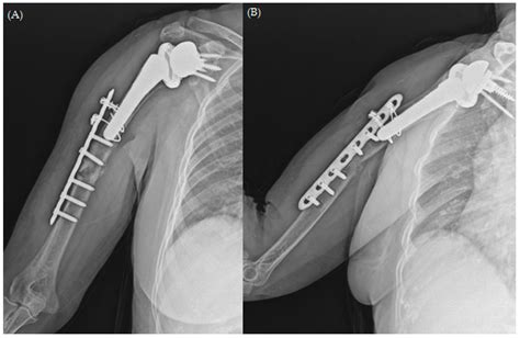 The Treatment of Periprosthetic Fracture Revision of the Humerus with ...