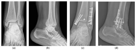 Fixation of Posterior Malleolus in Trimalleolar Ankle Fractures: Anteroposterior Screw or ...