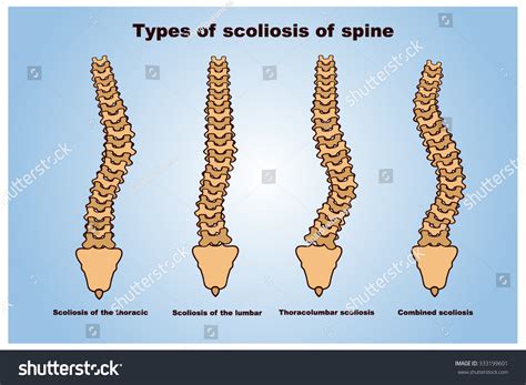 Types Of Scoliosis Of Spine Stock Vector 333199601 : Shutterstock