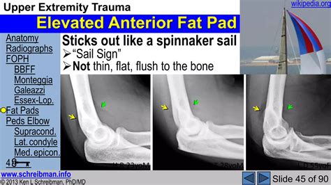 Upper Extremity Trauma Elbow & Forearm MSK Radiology Lecture | PPSX