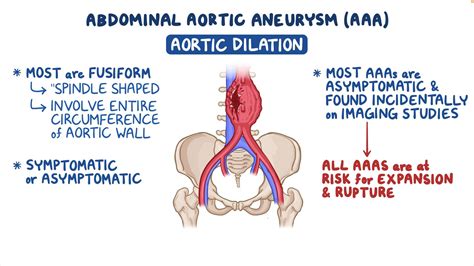 Abdominal aortic aneurysm: Clinical sciences - Osmosis Video Library