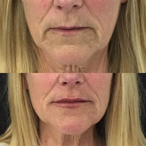 Marionette Lines And Jowls Treatment at Caleb Bateson blog