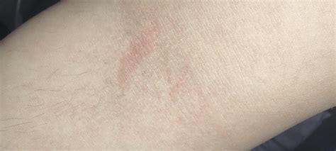 Red lines over veins : r/DermatologyQuestions