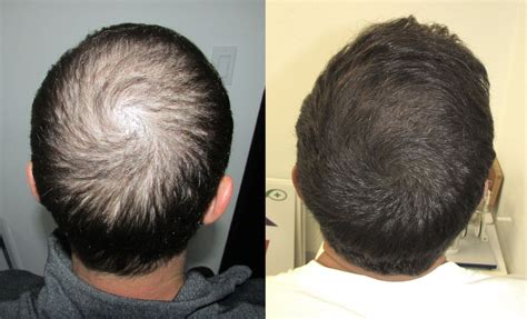 Best hair regrowth treatments for men regrowth products