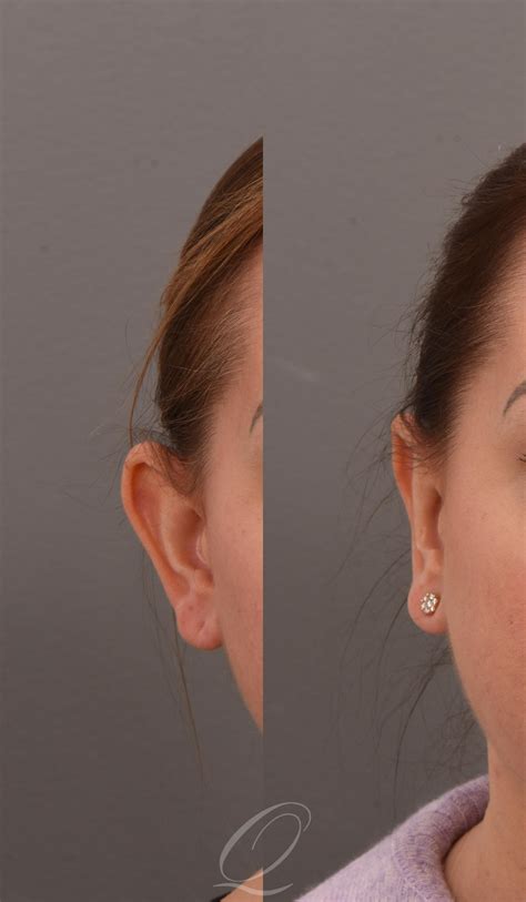 Otoplasty (Ear Pinning) for Rochester, Buffalo & Syracuse, NY - Quatela Center for Plastic Surgery