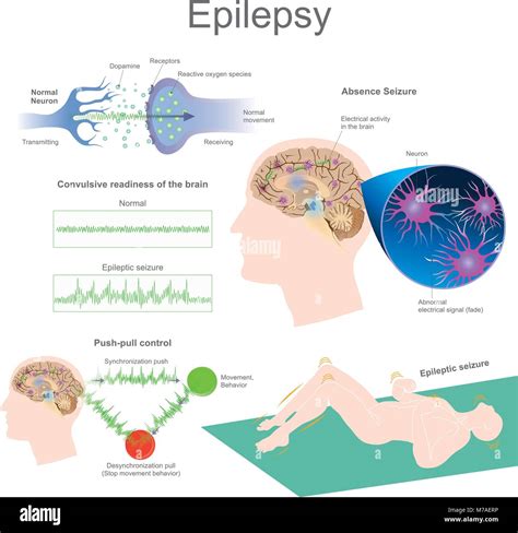Mechanism Of Epilepsy