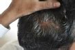Homeopathic Treatments for Hair Fall - HomeoCure® Homeopathy Clinic, Pune