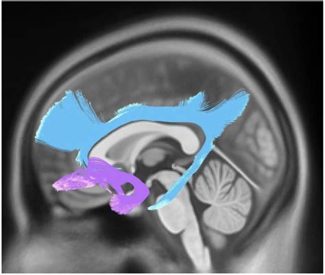 Cingulum and Uncinate Fasciculus Microstructural Abnormalities in ...