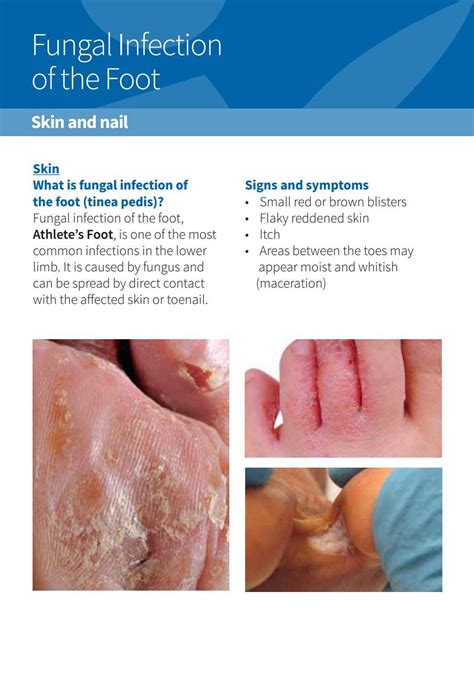 Foot Fungal Infection Blisters
