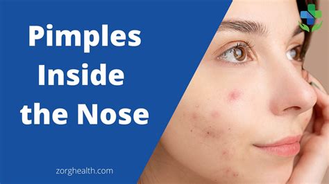 Learn about Pimples Inside the Nose - Zorg Health