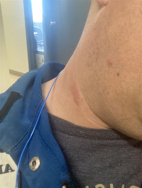 Spot on my neck that burns to the touch, voice is pretty hoarse too ...