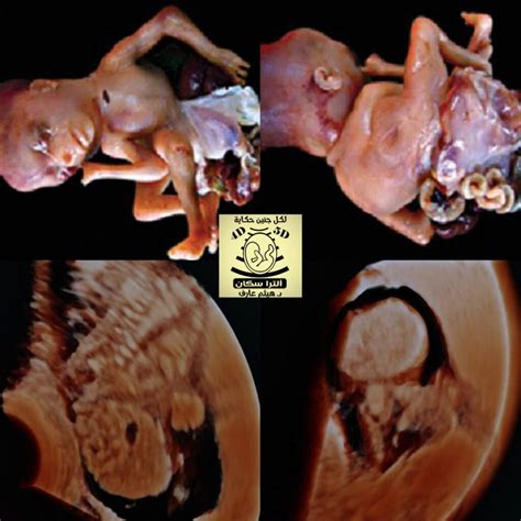 Limb Body Wall Complex