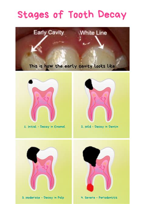 Early Cavity