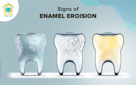 What Is Enamel Stain at Bessie Luce blog