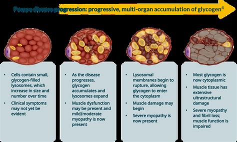 Pompe Disease Life Expectancy With Treatment