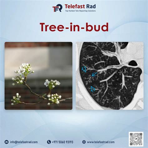 Tele Fast Rad on LinkedIn: ** Tree-in-bud pattern, not only in infection:** ️ First described in…