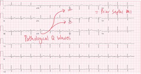 The Anatomy of Pathological Q Waves on ECG