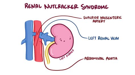 Nutcracker syndrome - types, causes, symptoms. What is the diagnosis and treatment? - Healthy ...