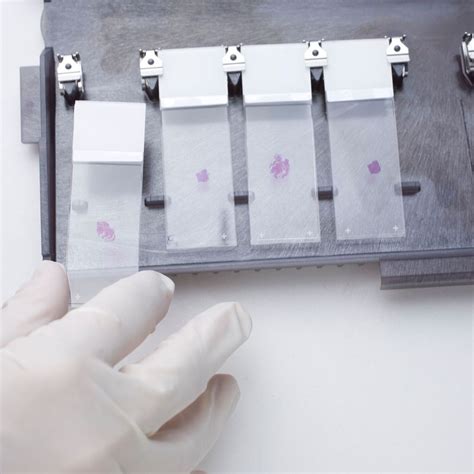 Mammakarzinom: Update Prognosefaktoren und Biomarker - Gynäkologie ...