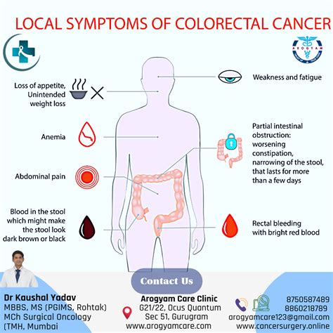 Colon Cancer : cause, symptoms, stages and treatment of 3rd most common cancer - CancerSurgery