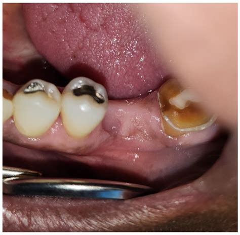 Prophylactic Use of Pentoxifylline and Tocopherol for Prevention of ...