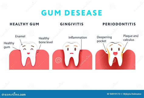 Step of Gum Disease. Healthy Tooth and Gingivitis Stock Vector - Illustration of formation, gums ...