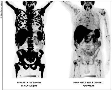 Stellenwert der 177Lutetium-PSMA-Therapie - Onkologie - Universimed ...