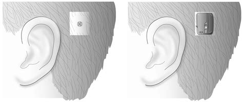 Bone Anchored Hearing Aid (BAHA) | Treatments | Patients & Families | UW Health
