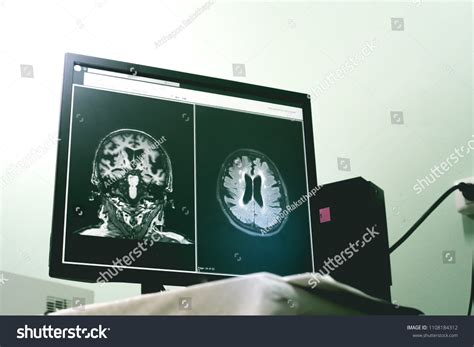 37 Cerebral Small Vessel Disease Images, Stock Photos & Vectors | Shutterstock