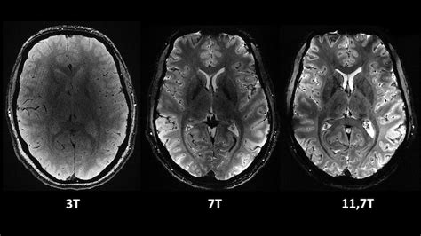 World's most powerful MRI machine unveiled, captures brain images in 4 ...
