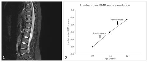 Atypical predominance of vertebral fractures as the first sign of ...